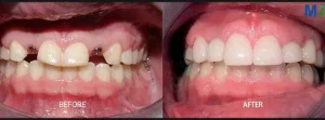 Dental Implants Before and After