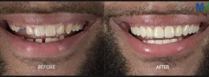 Dental Veneers – Before and After