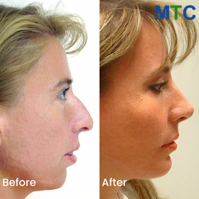 Rhinoplasty