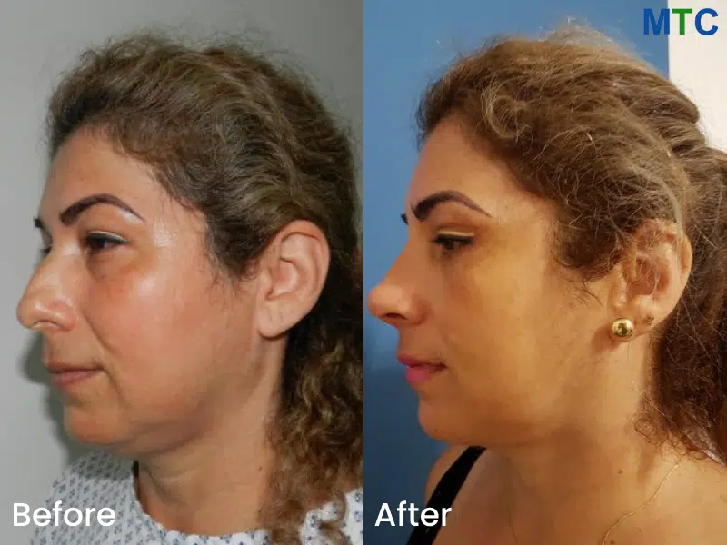 Dr.-Rafael-Velasco-Marin-Rhinoplasty-testimonials-3.jpg