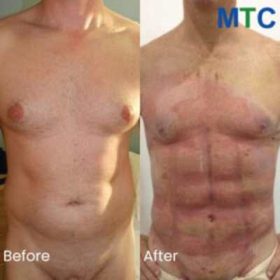 Male Breast Reduction