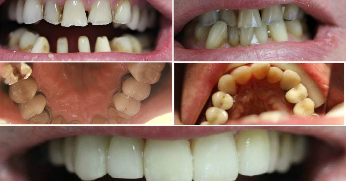 Full Mouth Restoration in Mexicali – Mexico