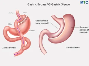 Gastric-BYPASS-VS-sLEEV