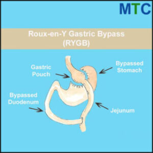 Gastric Bypass Surgery