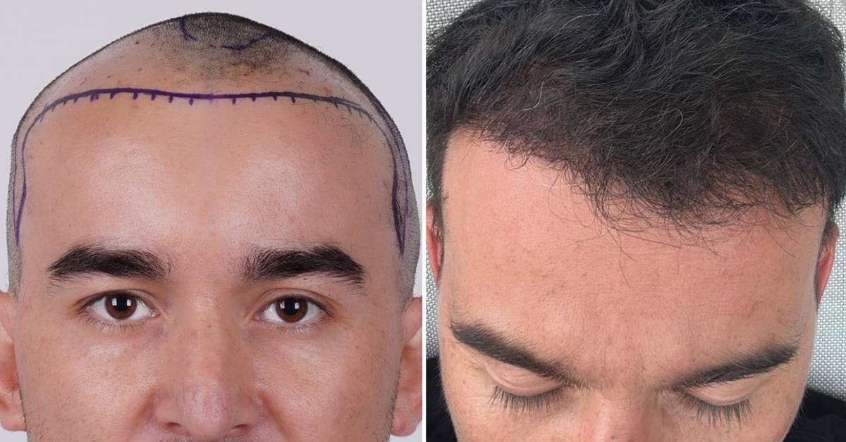 Hair Transplant Turkey