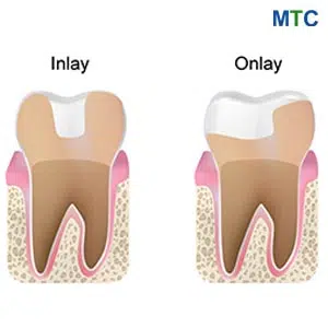 Inlays and Onlays