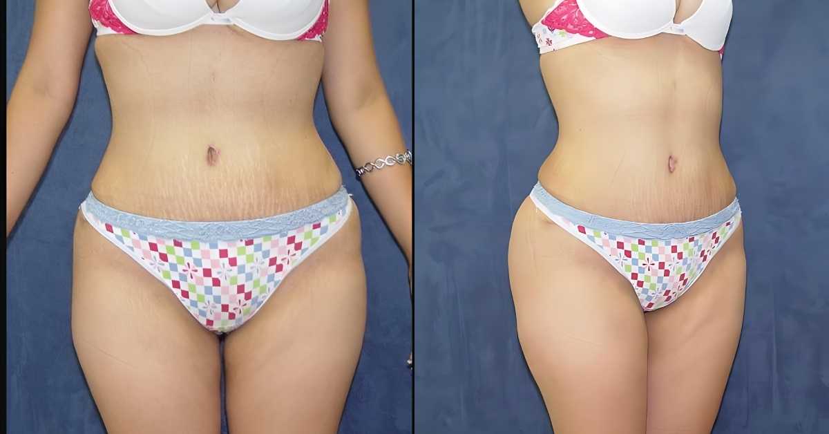 Liposuction in Costa Rica