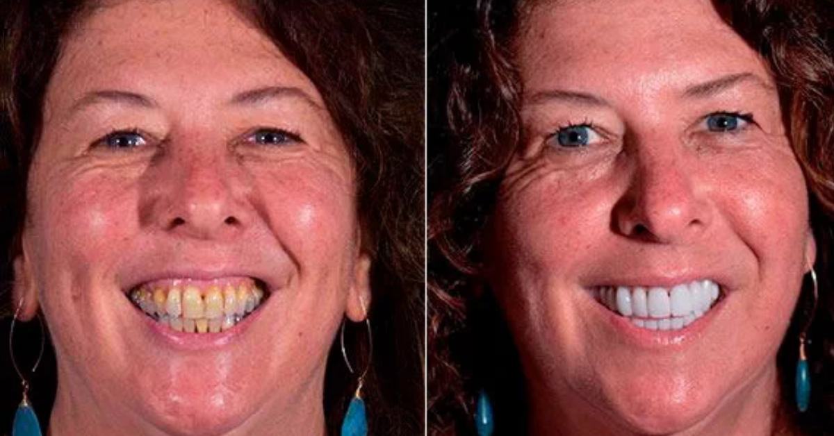 Low-Cost Full Mouth Restoration in Mexico