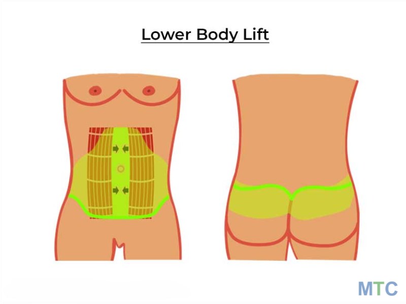 Lower Body Lift