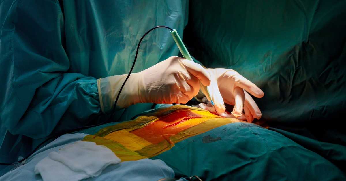 Organ Transplant Procedures