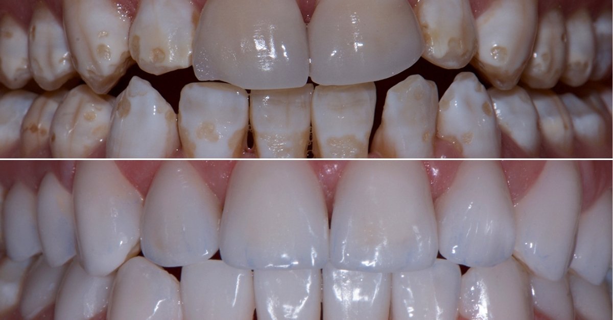 Porcelain Veneers in Cancun, Mexico