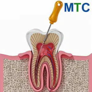 Infected Root Canal