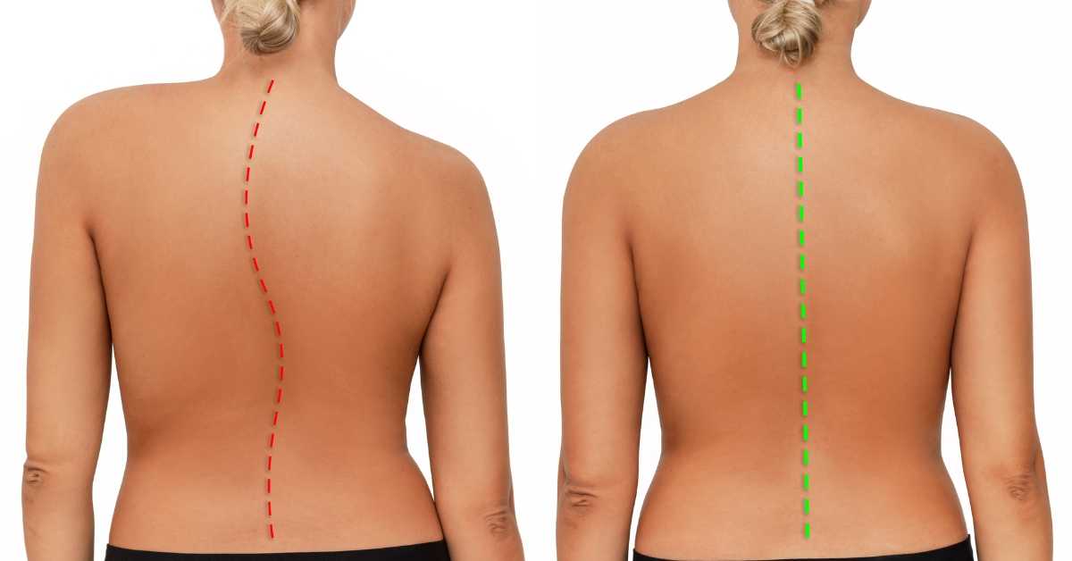 Scoliosis Treatment in Korea