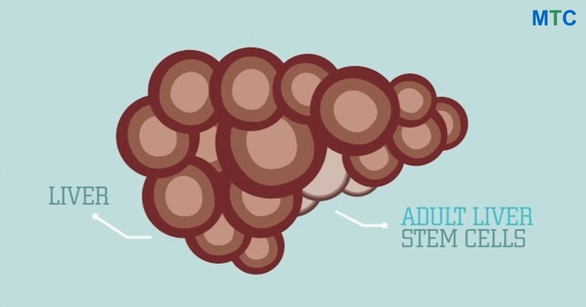 Stem Cells for Liver Disease in Mexico
