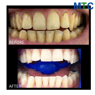 Teeth-Whitening-Before-After-in-Didim