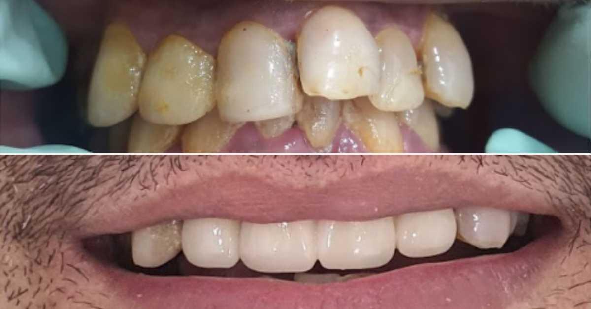 Tooth Contouring and Reshaping Abroad