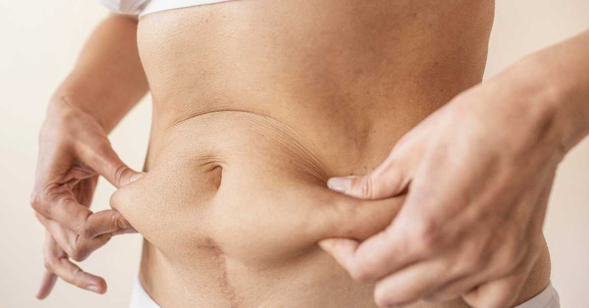 Tummy Tuck in Tijuana – Mexico