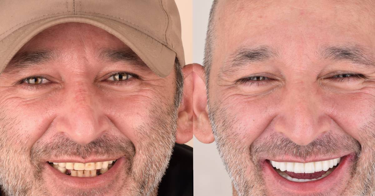 All on 4 Dental Implants, Istanbul, Turkey