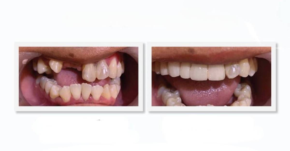 Dental Implants in Bali