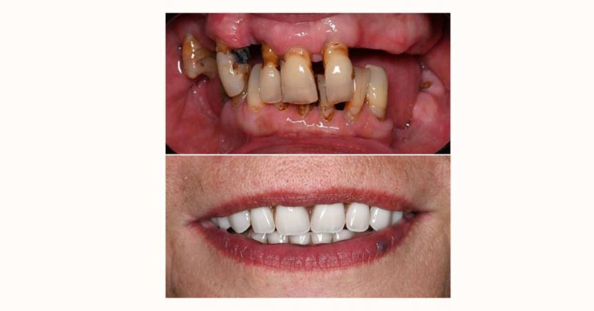 All-on-4 Dental Implants in Poland