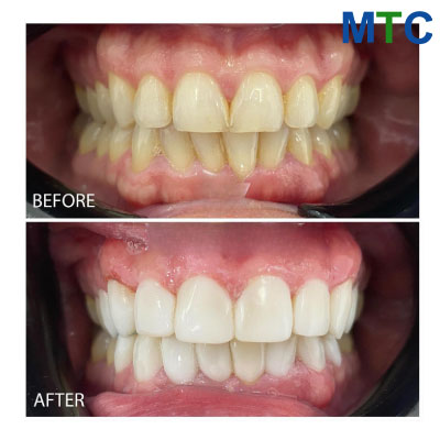 Veneers Before and After Didim