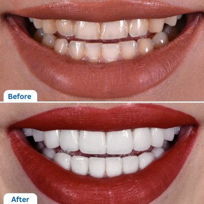 before & after dental veneers in istanbul