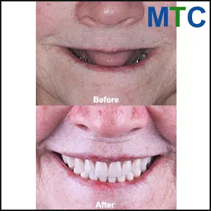 Before and After Dental Implants