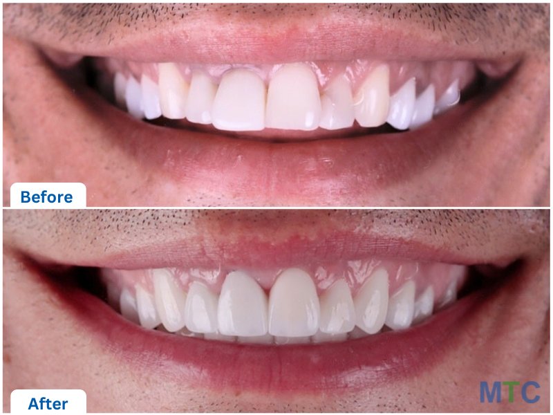 before & after veneers, istanbul