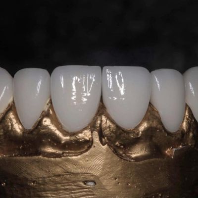 Close-up of E-Max veneers mounted on a dental model, highlighting their smooth, glossy finish and lifelike tooth appearance