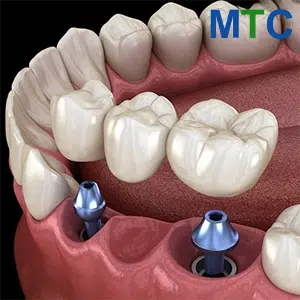 3-unit Bridge on Implants