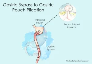 pouch plication