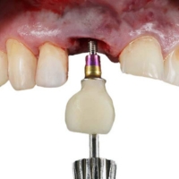 Single dental implant