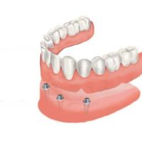 Single dental implant