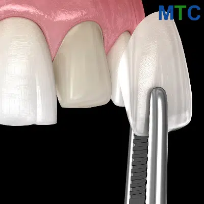 Dental Veneers