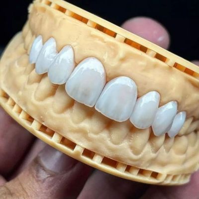 Zirconium veneers displayed on a dental model, showcasing their natural tooth-like appearance and craftsmanship, from a dental clinic in Istanbul