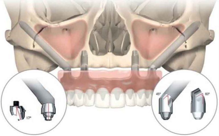 Zygomatic Implants