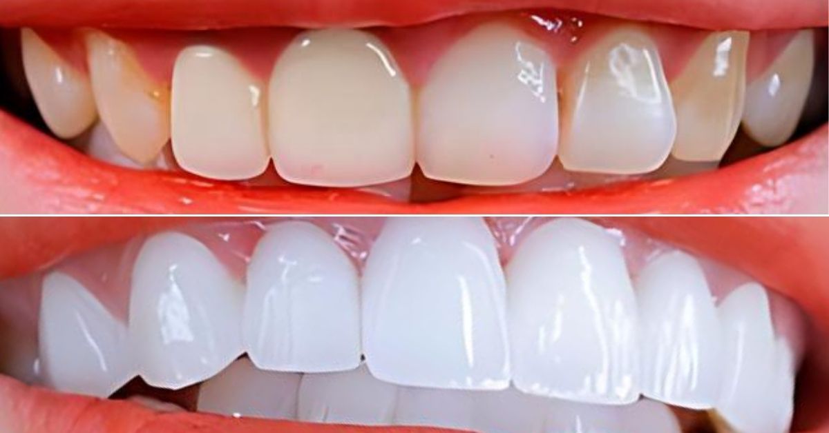 Dental Veneers In Vietnam