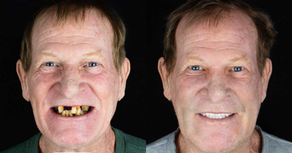 Full Mouth Implants in Mexico