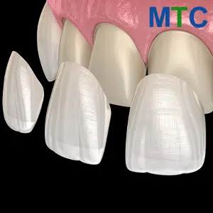 Porcelain Veneers