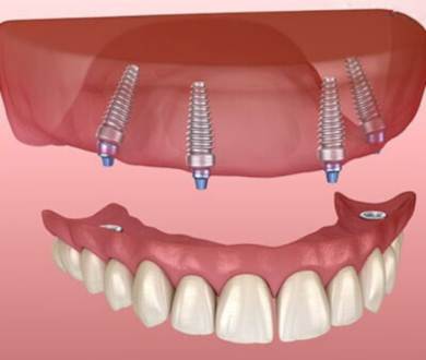 All on 4 dental implant