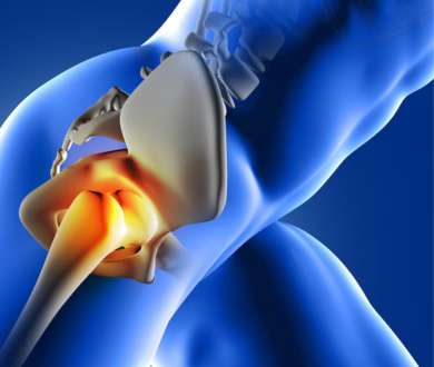 Hip replacement