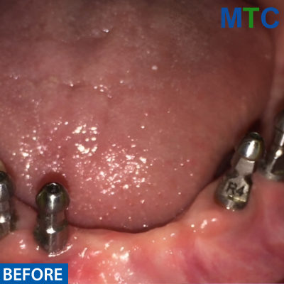 Before Dental Implants in Panchkula - Case#2