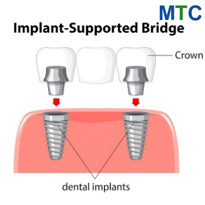 Implant Supported Bridge