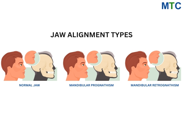 Jaw Alignment Types