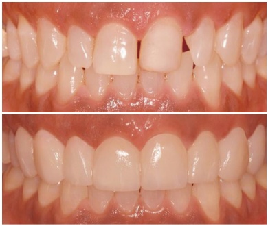 Smile Veneers All-Inclusive Package