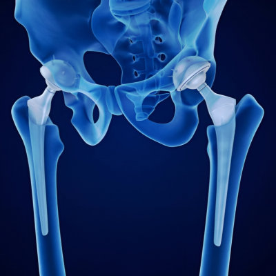 Bilateral Hip Replacement