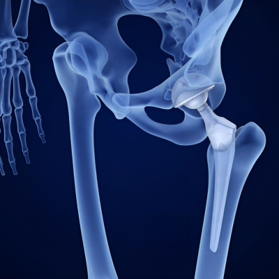 Unilateral Hip Replacement