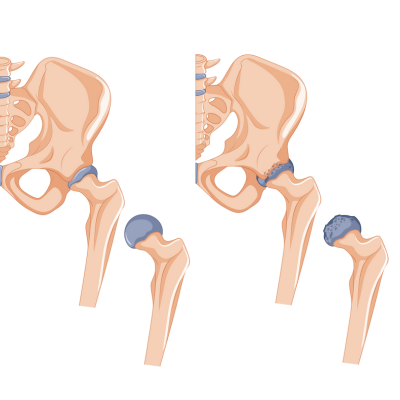 Animated diagram comparing normal hip joint and hip joint with arthritis