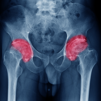 Diagnostic X-ray revealing osteoarthritis in the affected joint