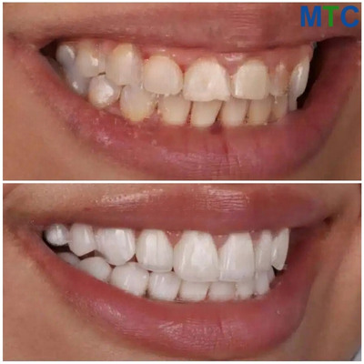 Dental Veneers - Before & After